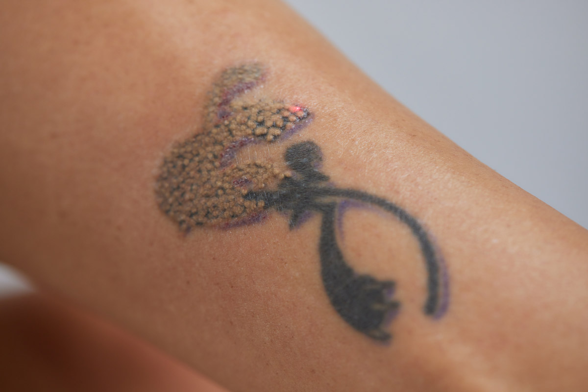rimozione tatuaggi